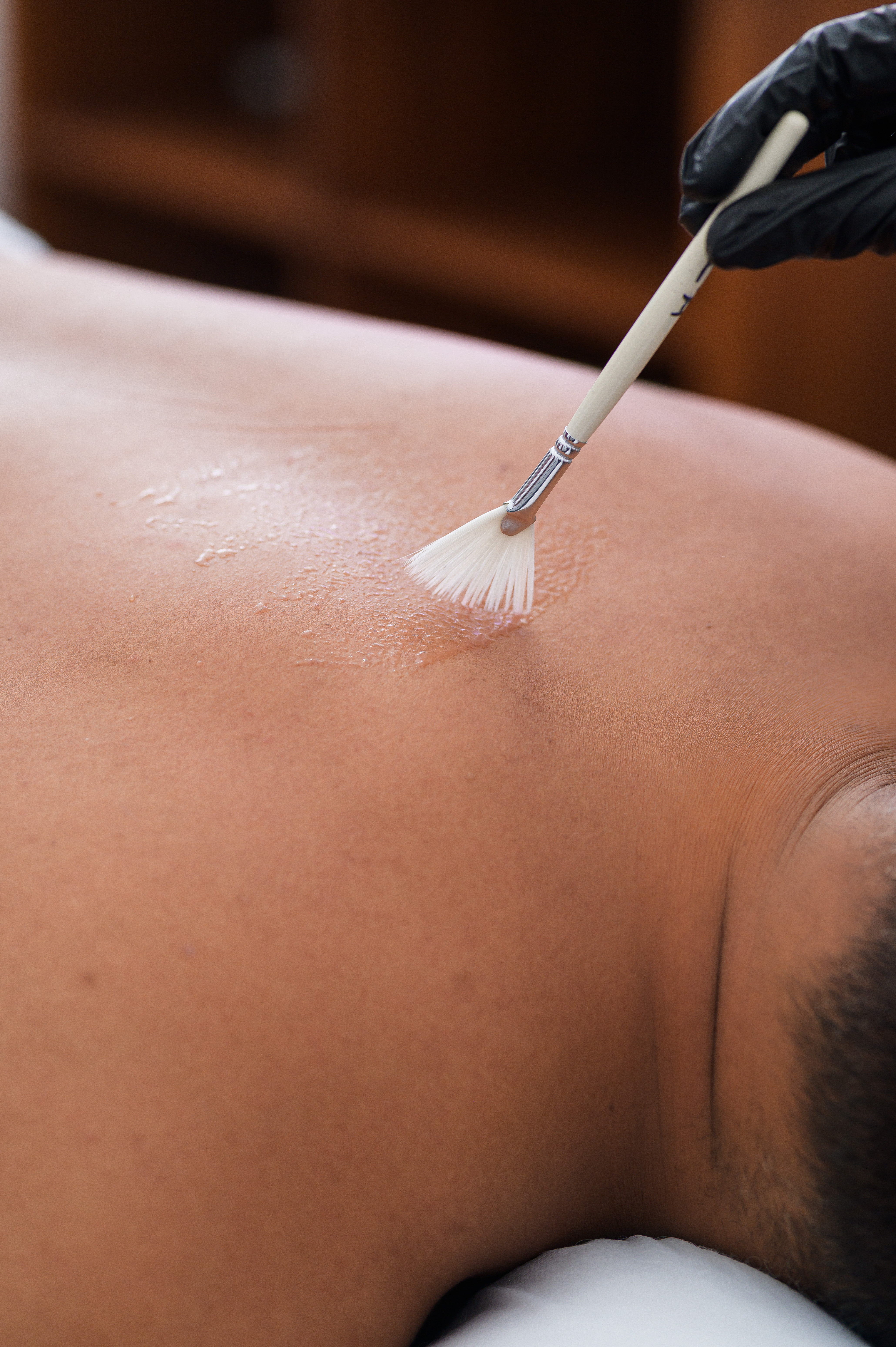 Chemical Peel Procedure