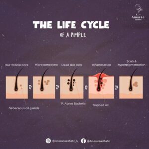 Illustration of acne on skin