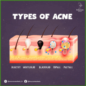 Adult acne around jawline and chin