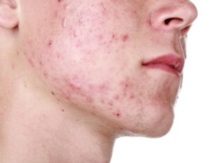 Diagram showing factors causing acne