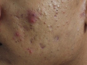 Different types of acne on skin