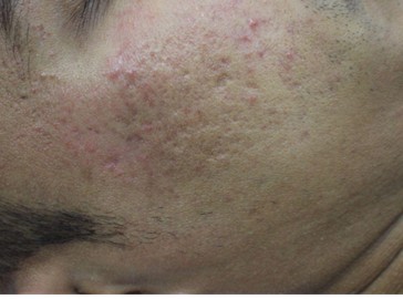 Chemical Peel Procedure