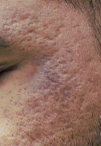 Chemical Peel Procedure