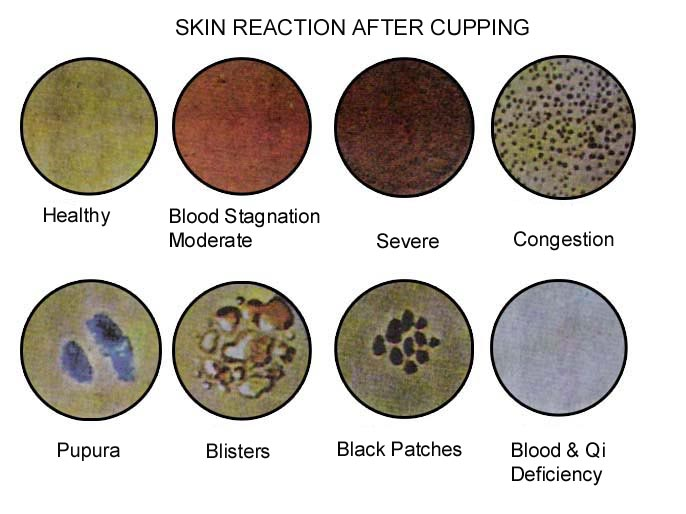 Cupping Therapy