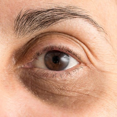 Causes of Dark Circles