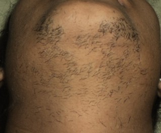 Hirsutism Condition