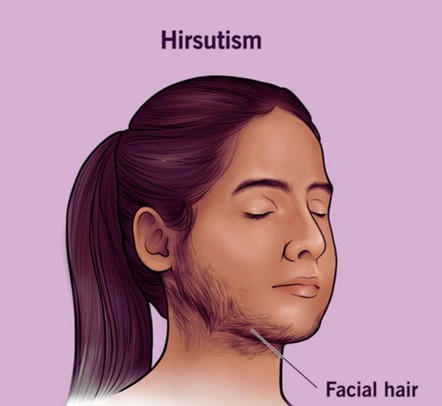 Hirsutism Hair Growth Areas