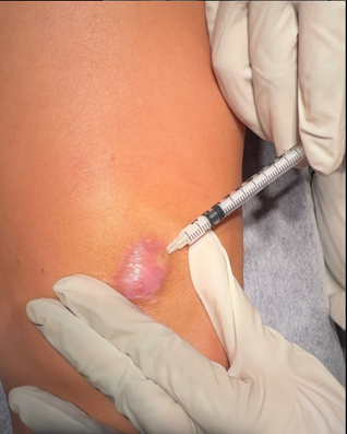 Keloid Scar Example