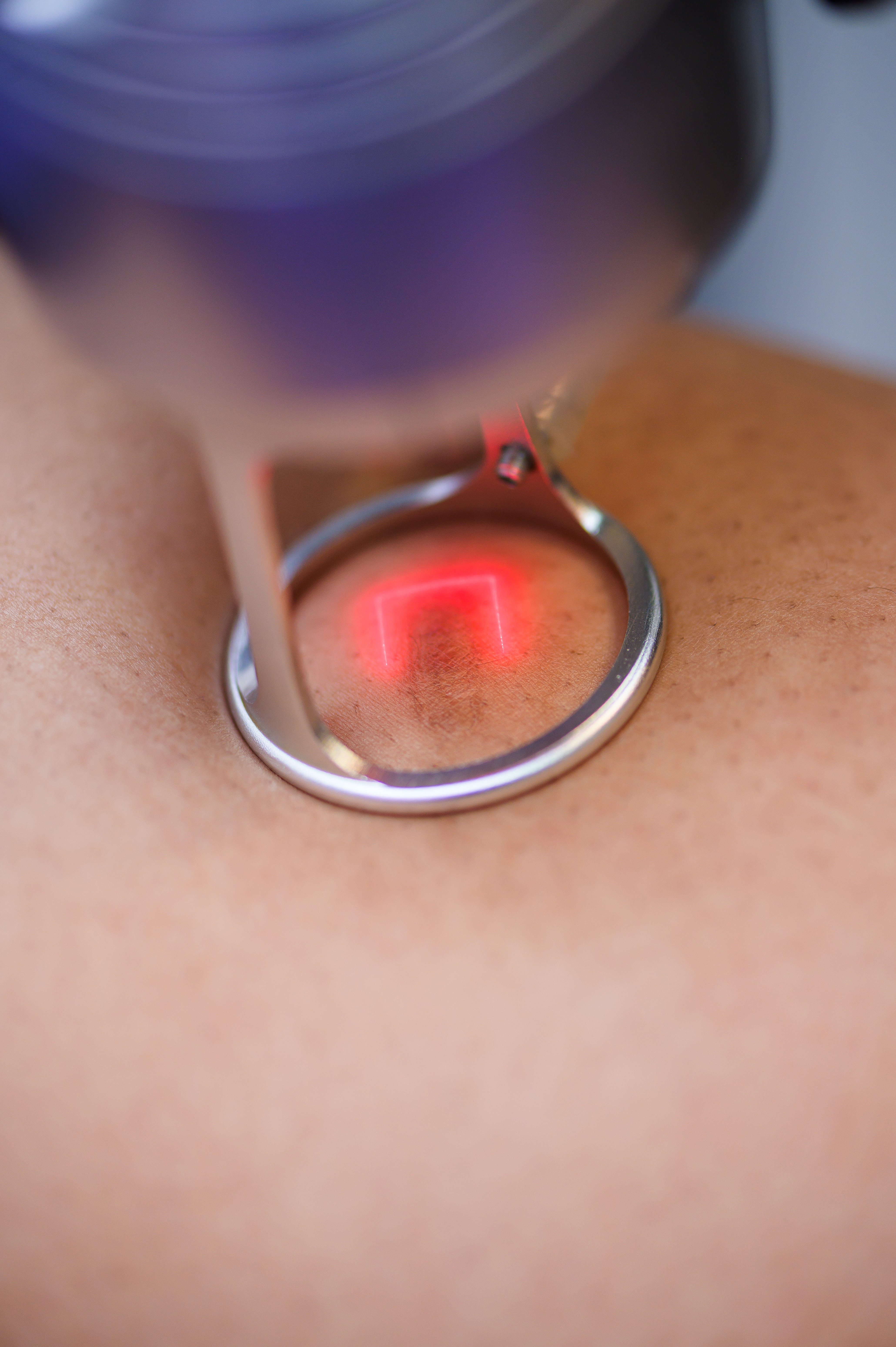 laser-scar-resurfacing