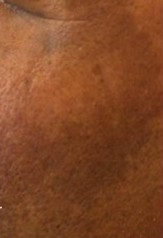 Melasma Treatment at Amaran