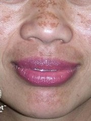 Melasma Affected Areas