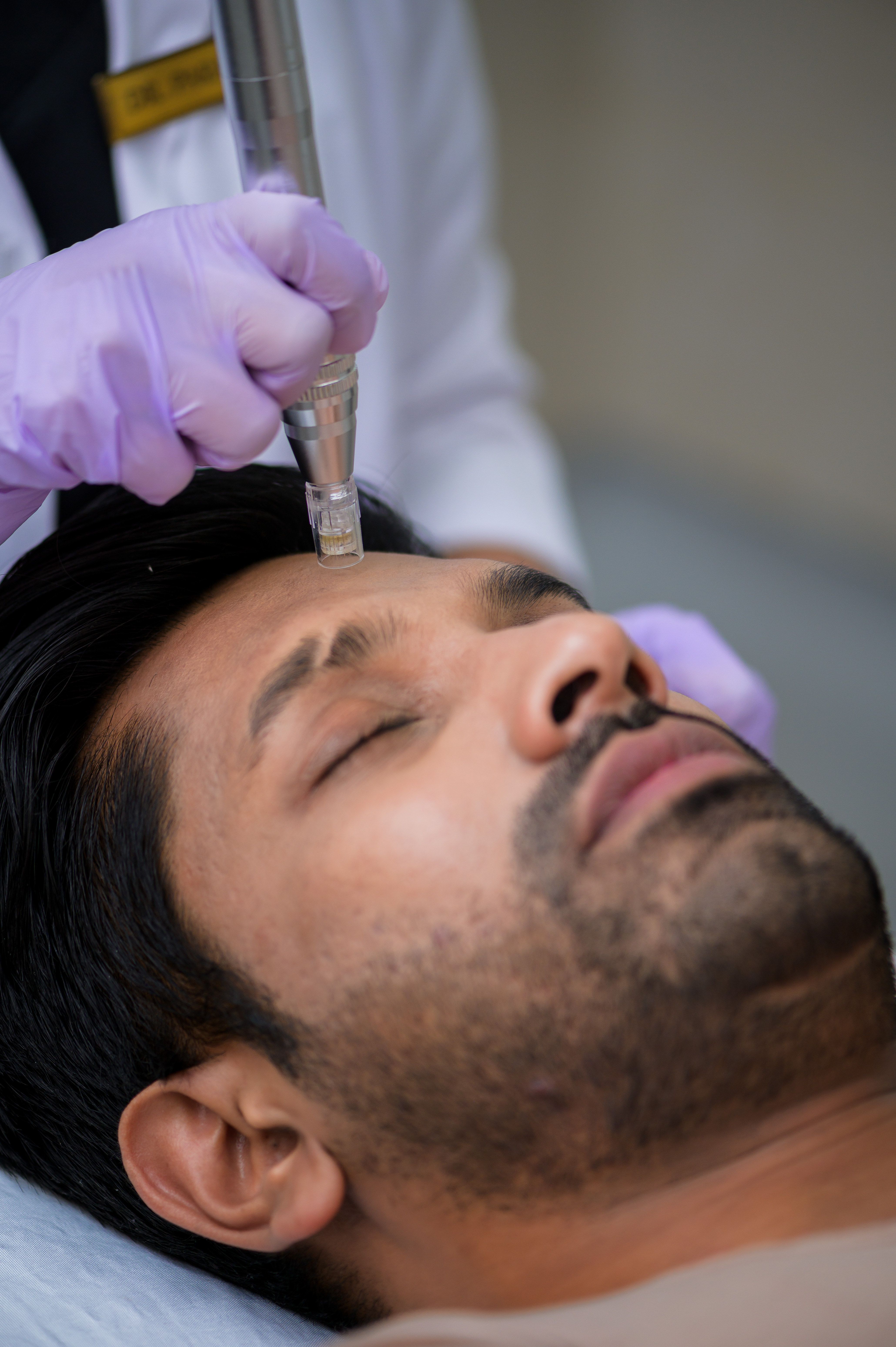 micro-needling
