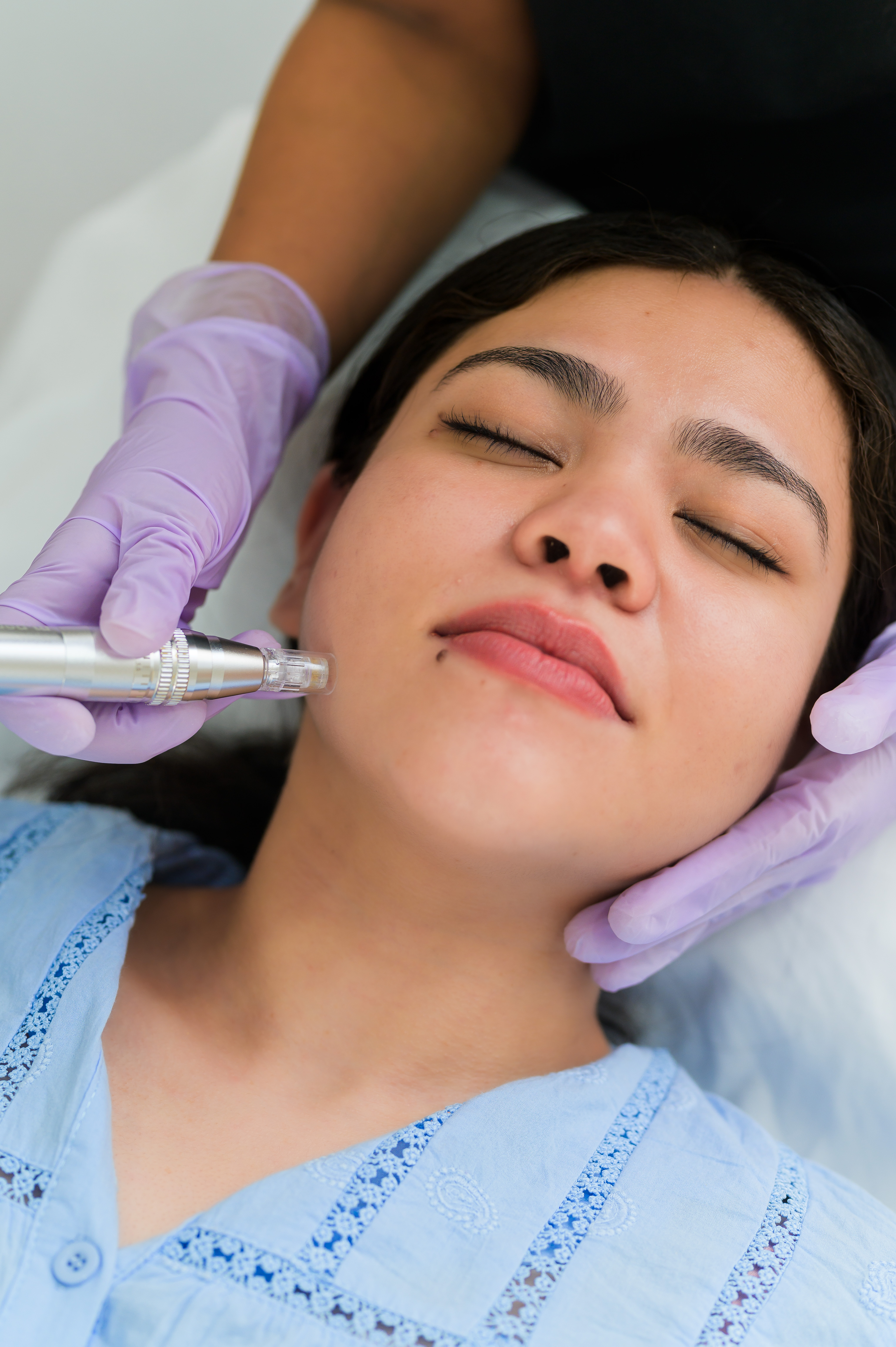 micro-needling