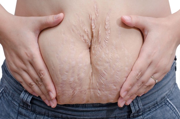 Stretch Marks